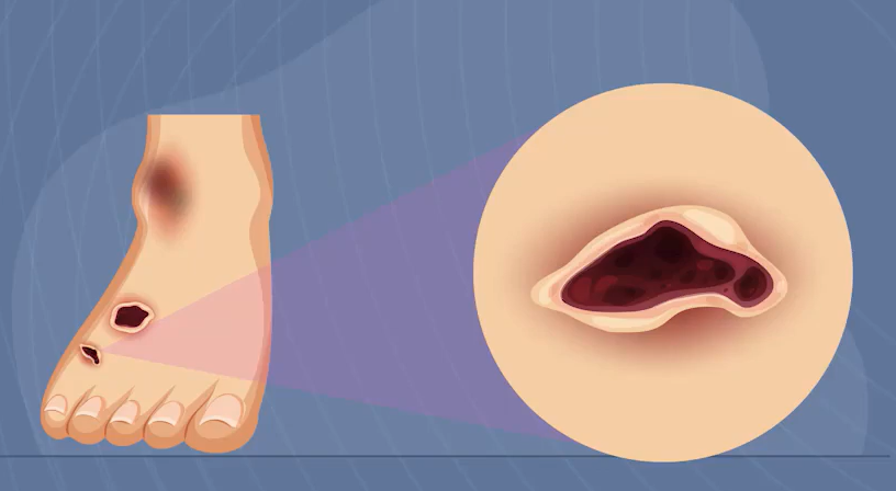 62 - Capacitación en indicación de ayudas técnicas de descarga en úlceras en el pie diabético (04/05/2026 - 29/05/2026)